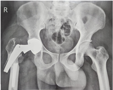 X ray pelvis shows bipolar prosthesis with displaced peri-prosthetic fracture right proximal femur (Type AL) through the middle of the femoral stem.
