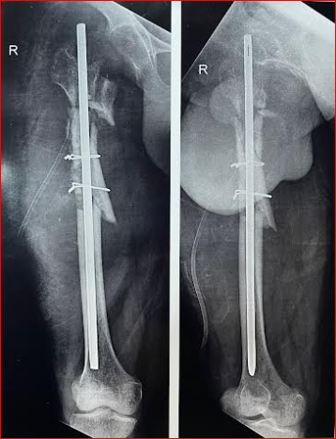Post-operative x ray right thigh showing segmental fracture and fracture of lesser trochanteric area of right femur with K nail and cerclage wiring and excisional arthroplasty of Hip.
