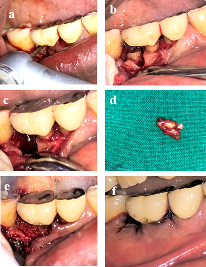 a: Resection of distal tooth using carbide bur after flap reflection; b: After resection of tooth; c: After extraction of distal root of 46; d: Extracted fragment; e: Bone graft and PRF placed; f: Suture placed.