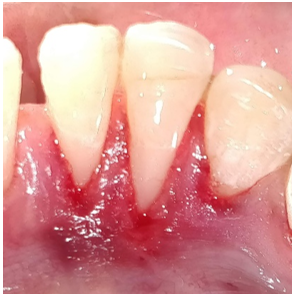 Crevicular incision