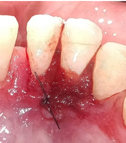 Mucograft stabilized using sutures
