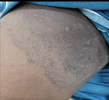 Tinea cruris