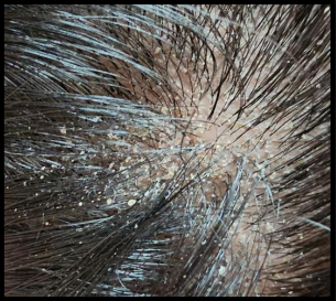 Seborrhoeic dermatitis