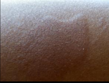 Whealsin the forearm (urticaria)