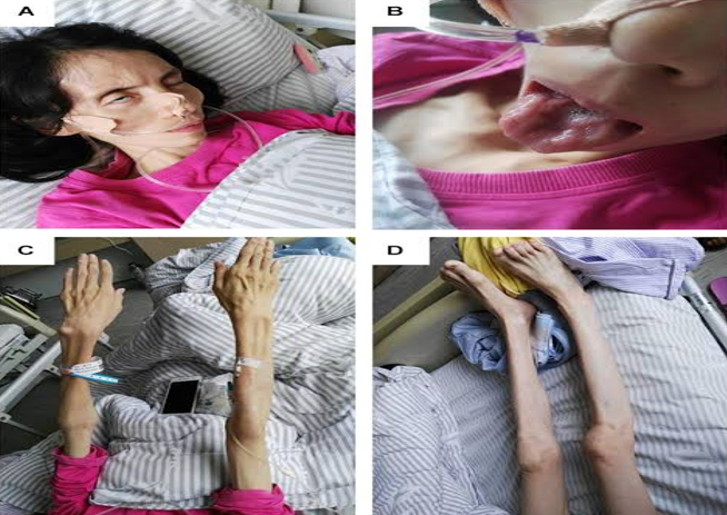 Motor neuron disease