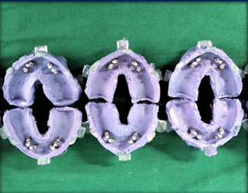 Polyether impressions with attached implant analog