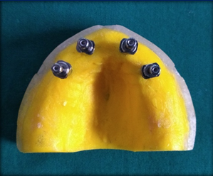 Master model 1 with transfer impression copings