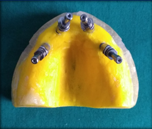 Master model 2 with transfer impression copings