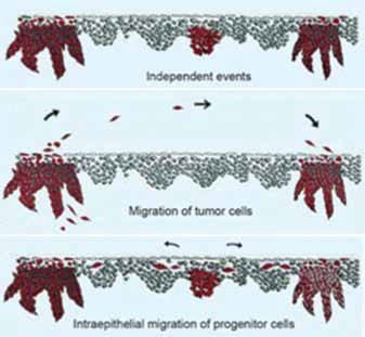 Mechanisms of oral fieldcancerization showing (a) independent events, (b) migration of tumor cells, and (c) intraepithelial migration of progenitor cells25