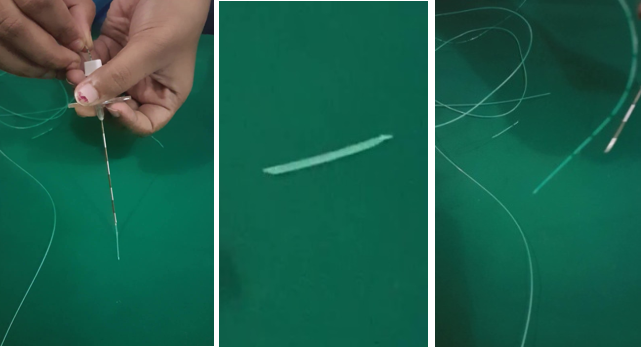 Images showing broken tip of epidural catheter during attempted withdraw.