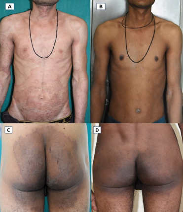 Improvement in lesions with Itraconazole + Ciclopirox Combination; A, C- Extensive tinea corporiset cruris at baseline; B, D- Complete resolution of symptoms after 6 weeks of therapy