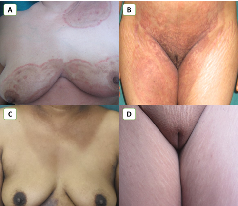 Improvement in lesions with Itraconazole + Luliconazole Combination; A, B- Extensive tinea corporiset cruris at baseline; C, D- Complete resolution of symptoms after 6 weeks of therapy