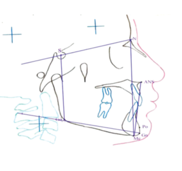Cephalometric landmarks and planes.