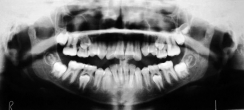 Panoramic radiograph of female child of 9.58 years chronological age.