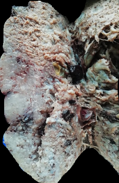Cut section of placenta showing myxoid areas