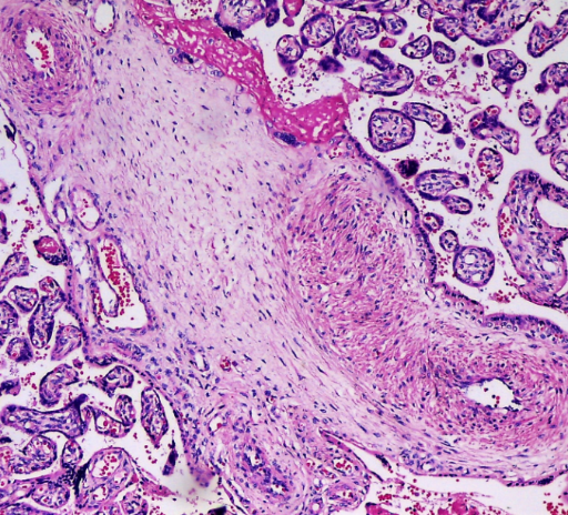Photomicrograph showing thick walled blood vessels in a loose myxoid stroma