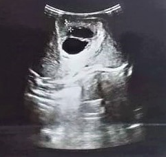 USG ofnewborn showing cystic lesion consistent with mesenchymal hamartoma