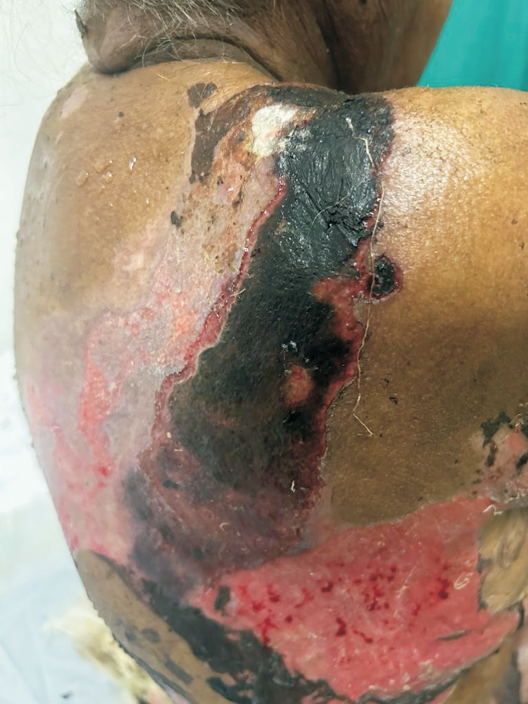 Necrotic patch over right scapular region