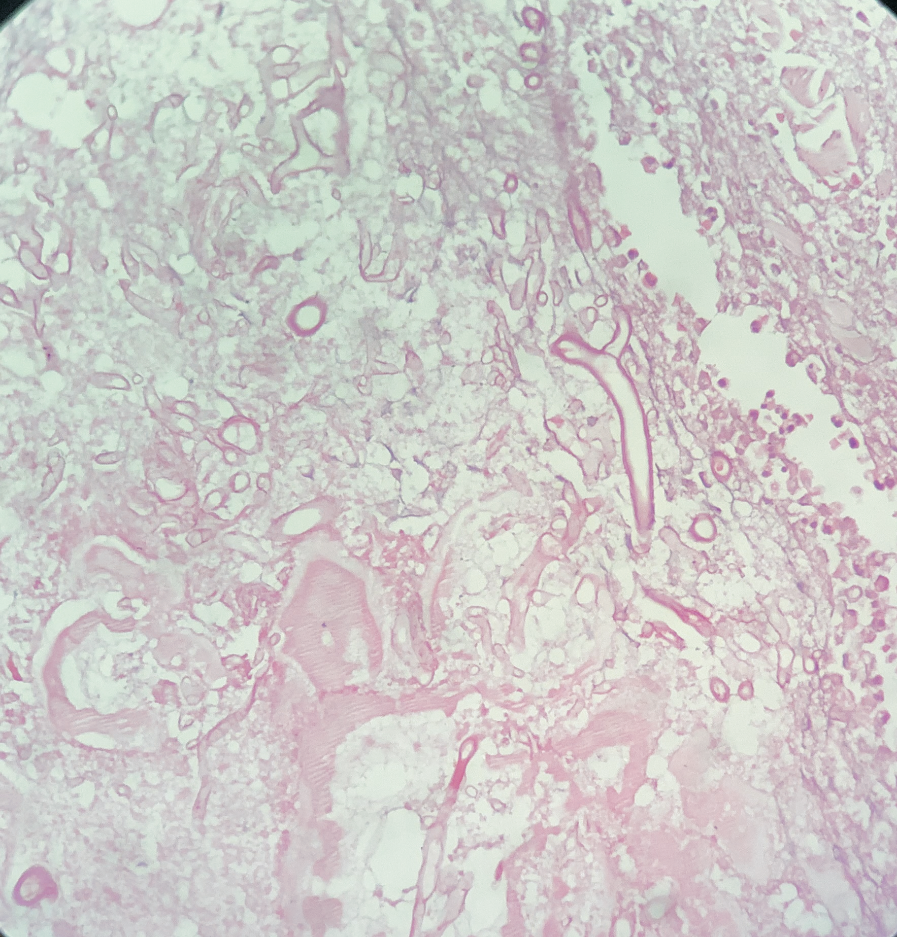 Photo micrograph showing multiple broad non-branched aseptate fungal hyphae [H&E, 400X]