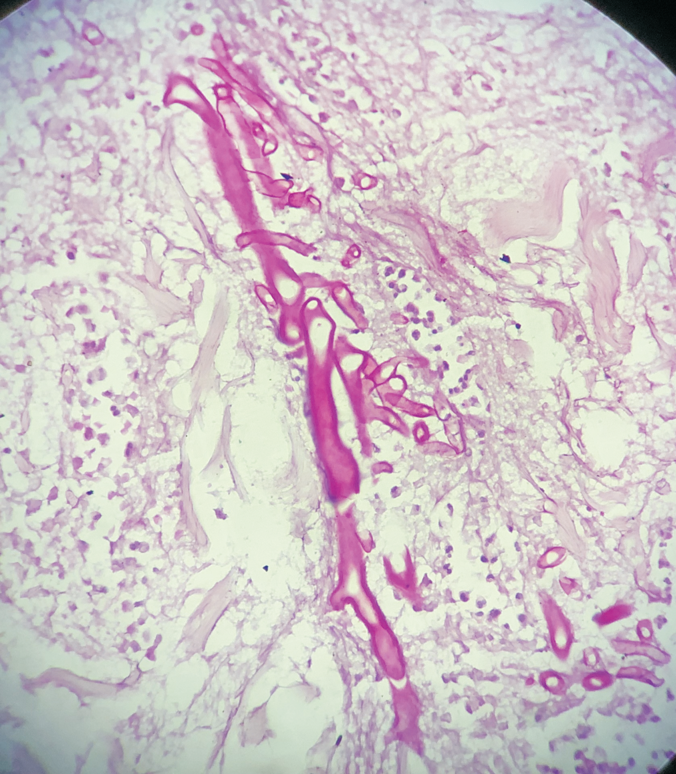 Periodicacid schiff stain highlighting aseptate broad fungal hyphae [400X]