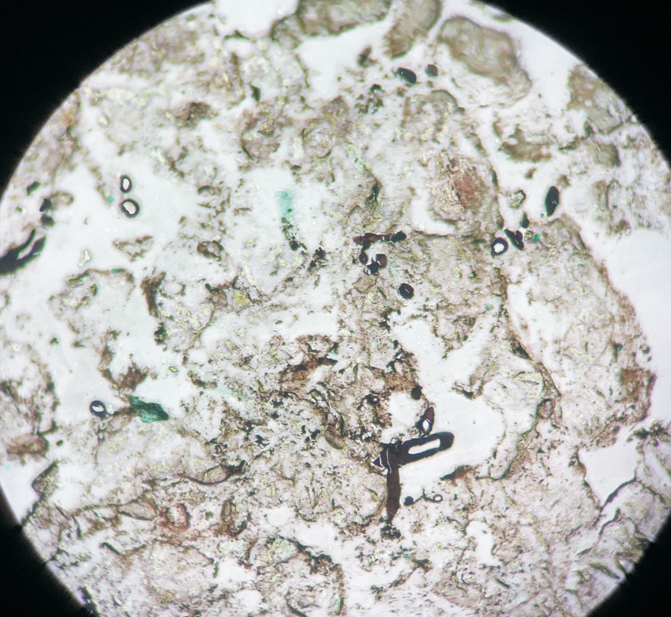 Gomori methenamine silver stain highlighting aseptate broad fungal hyphae [400X]