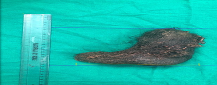 Figure showing the trichobezoar