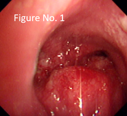 Globular lesion seen in carina and right main bronchus