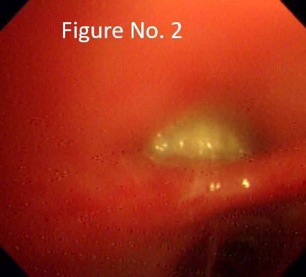 White glistening endobronchial lesion occluding Right middle lobe bronchus