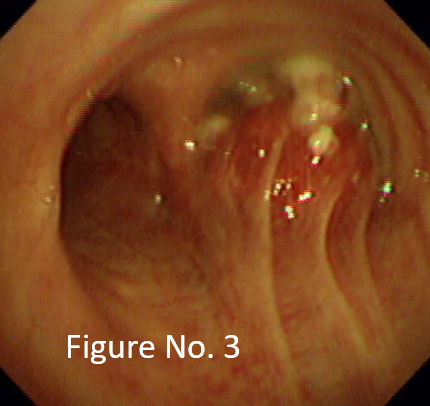 Globular growth causing near total occlusion of right main bronchus
