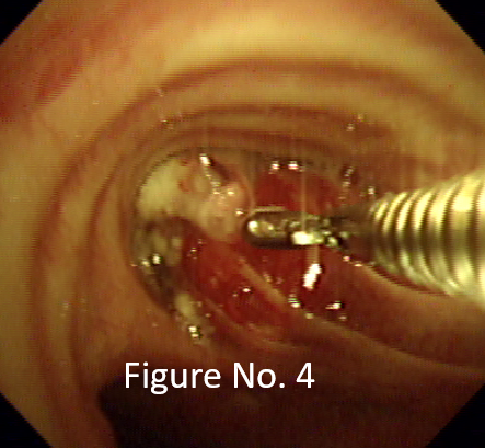 Endobronchial biopsy of growth seen
