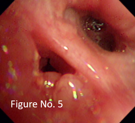 Multiple nodular lesions in left main bronchus.