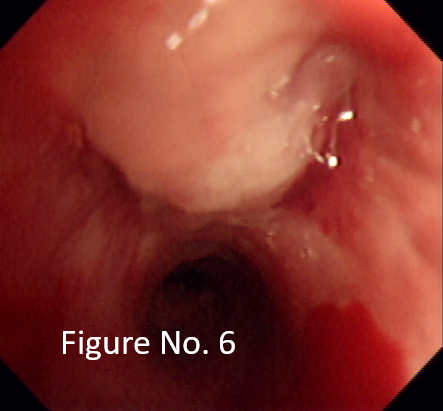 Fungating lesion obstructing in right upper lobe bronchus
