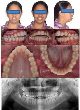 Pre-treatment extra-oral, intra-oral photographs and Panoramic radiograph.