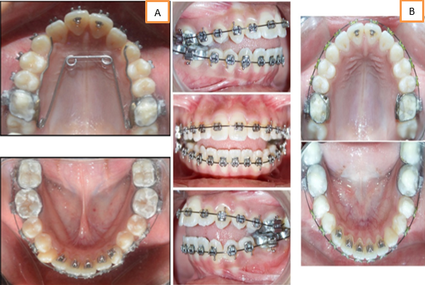 Posteriorcrossbite correction with quad helix. b: Posterior bite raised with glass ionomer cement.