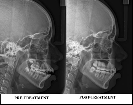 Comparative lateral cephalogram.