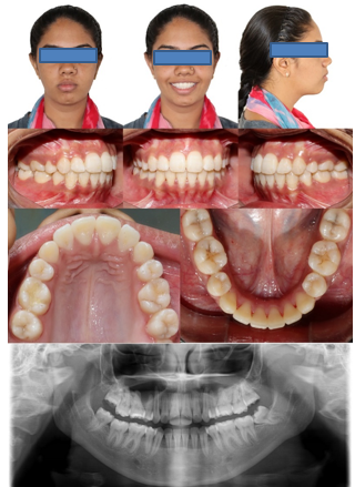 Posttreatment extraoral, Posttreatment intraoral, posttreatment Orthopantomogram.