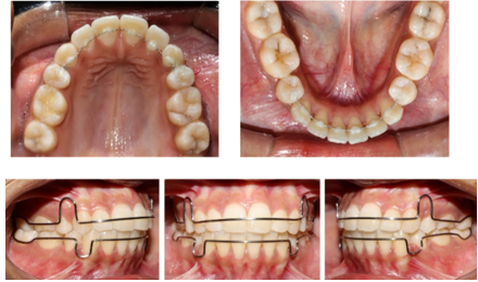 Begg’s Wrap around Retainer.