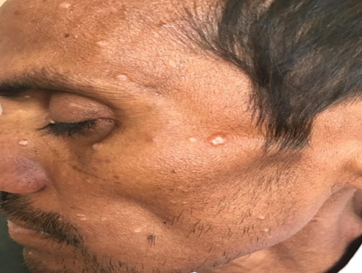 Molluscum contagiousum on face