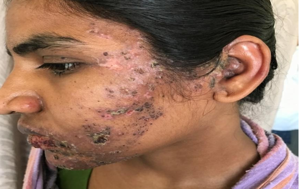 Herpes zoster
