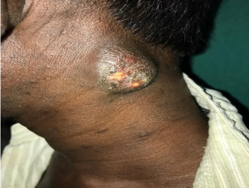 Scrofuloderma