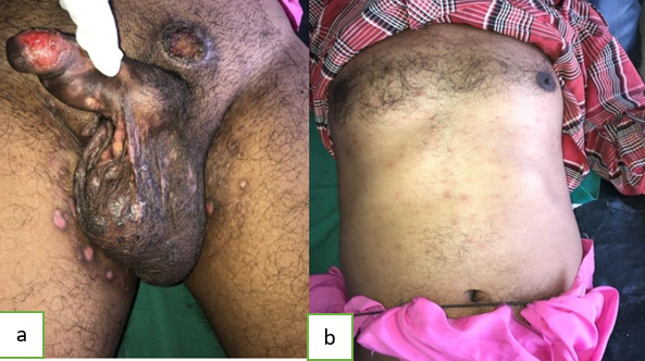 a,b: Secondary syphilis with maculo papular rash on trunk