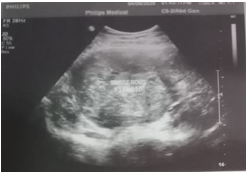 Tranabdominal ultrasound revealing a large hateogenous, well define predominantly hypoechoic mass in left adnexal region.