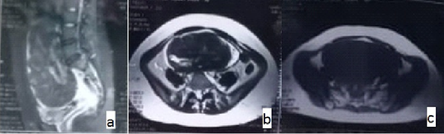 a: T2 sagittal image revels largelobulated hat erogenous predominantly hypo intense mass in pelvis, b: T2 axial-The mass is predominantly hypo intense with few hyper intense areas within the rights side, c: T1 axial-The mass is homogenously hypo intense on T1 weighted image.