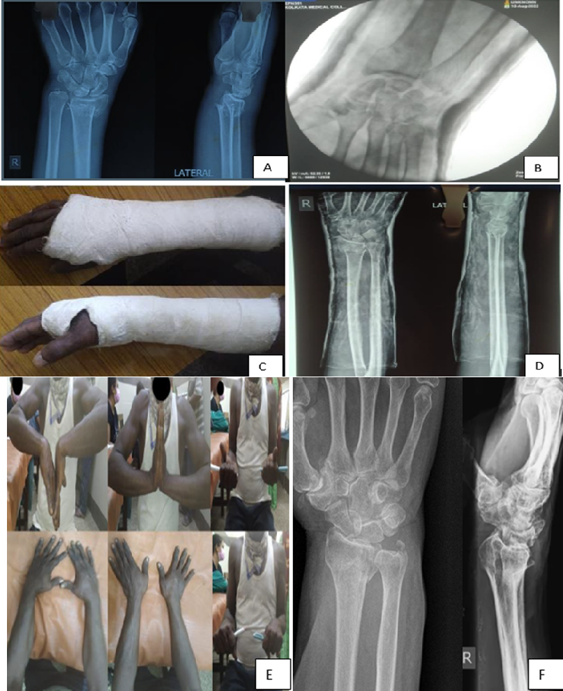 A): Pre-op radiograph, B): Intra-op C-arm image, C): Below elbow cast, D): Immediate radiograph, E): ROM at 1 follow-u, F): Radiograph at 1 yr follow-up