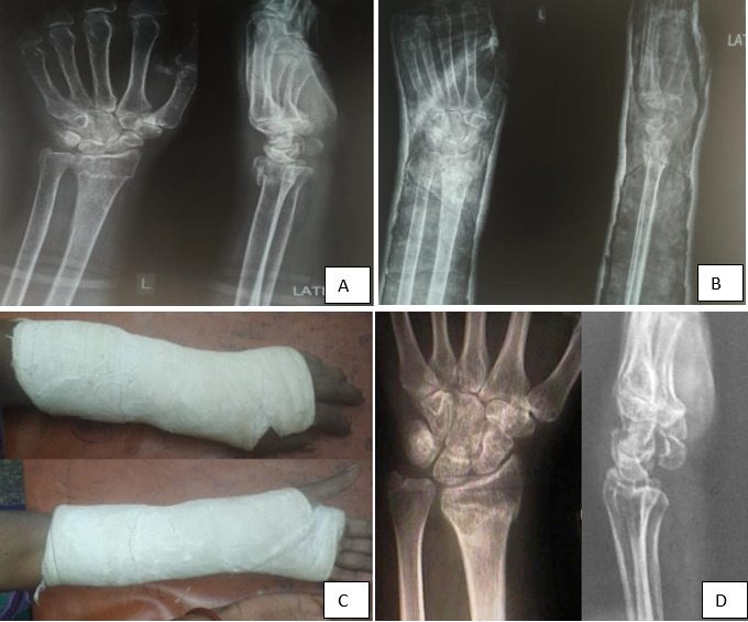 A): Pre-op radiograph, B): Post-op radiograph, C): With below elbow cast, D): Radiograph at 1yr follow-up
