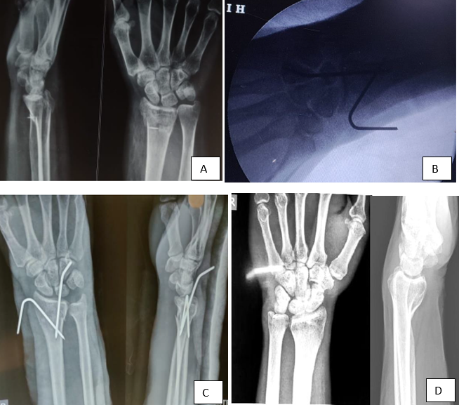 A): Pre-op radiograph, B): Intra-op C-arm image, C): Immediate Post-op radiograph, D): 1yr post-op radiograph