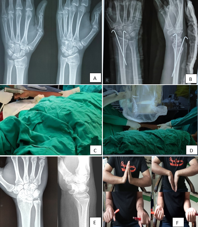 A): Pre-op radiograph, B): Immediate post-op radiograph, C): Intra-op clinical photo, D): Intra-op clinical photo, E): Radiograph at 1yr follow-up, F): ROM at 1yr follow-up