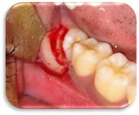 Cross-sectional tooth cutting