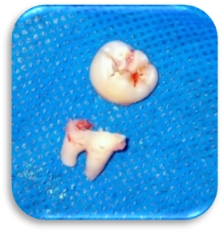 Sectioned tooth