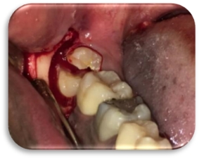 Longitudinal tooth sectioning